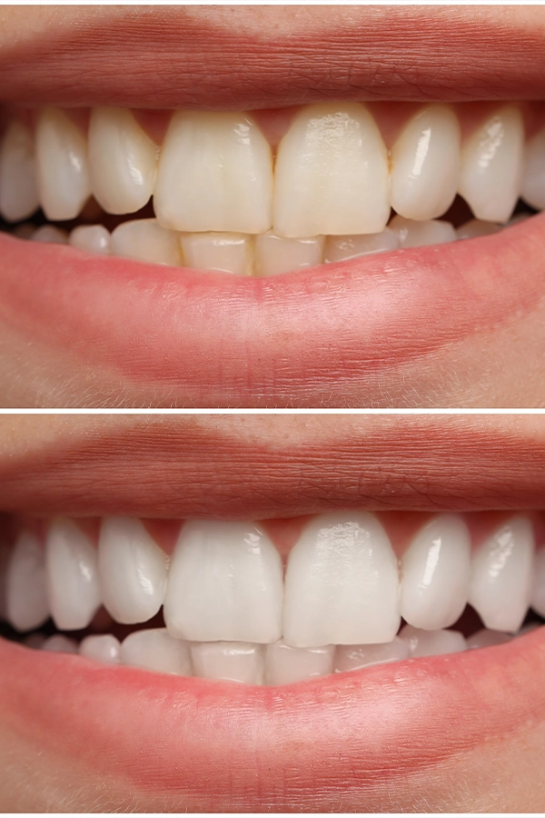 Dental Whitening Hollywood smile result